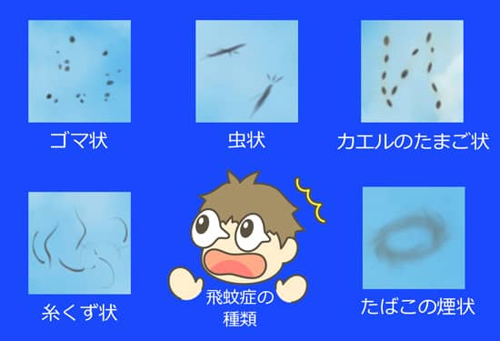 飛蚊症の種類