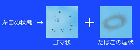 飛蚊症の見え方