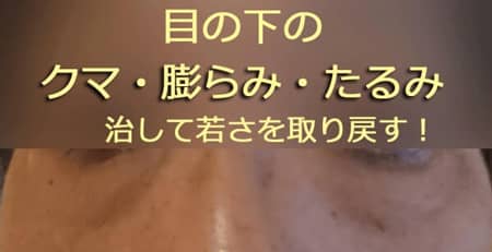 老化による目の下のクマとたるみ