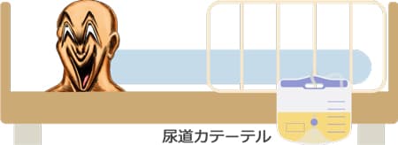 尿道カテーテル
