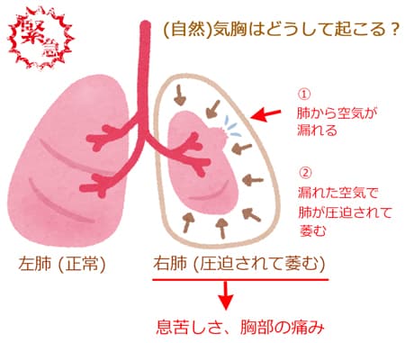 気胸はどうして起こるのか①(画像)
