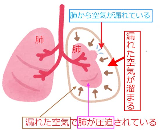 気胸はどうして起こるのか②(画像)