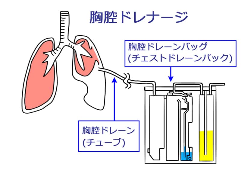 胸腔ドレナージ(画像)