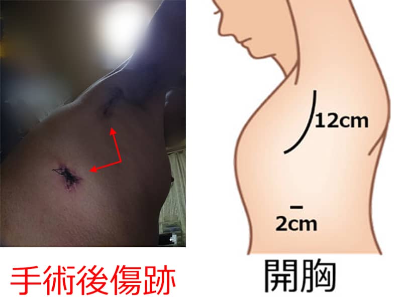手術で切開した傷跡(画像)