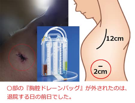 胸腔ドレーンバック(画像)