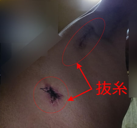 抜糸する場所(画像)